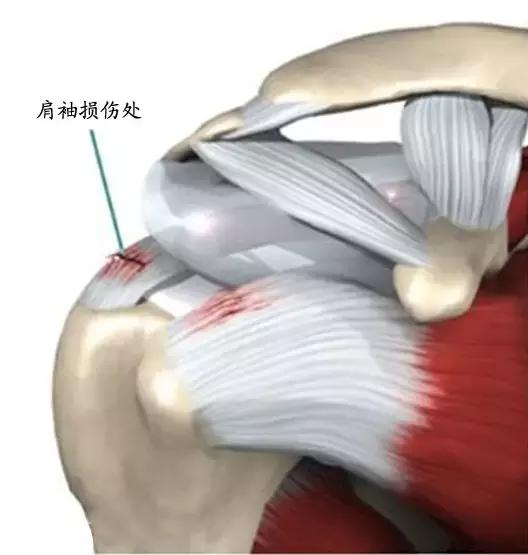 左肩膀疼痛警惕四种原因,肩膀痛活动有咯噔响声是什么原因