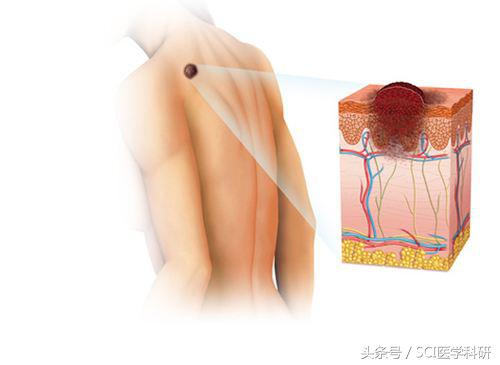 黑色素瘤转移无靶向药能救吗,转移性恶性黑色素瘤找不到原发灶