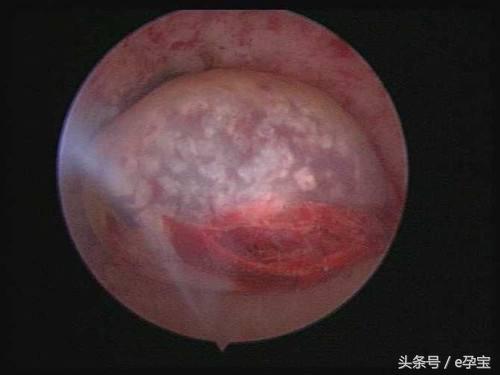 停胎和先兆流产有什么症状,孕早期胎停和正常流产流程一样吗