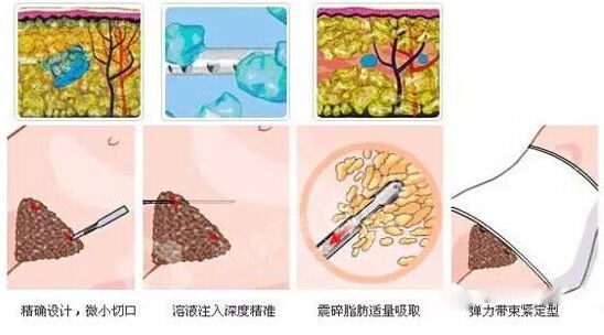 什么是腰腹抽脂,什么叫抽脂腰腹