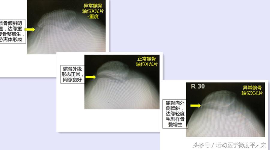 膝关节上楼不疼下楼疼是怎么回事,上楼时膝关节疼痛吃什么药