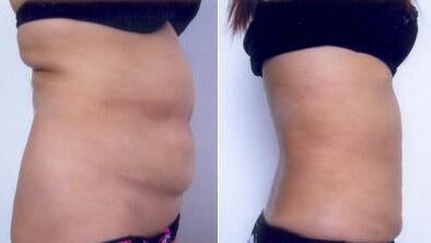 什么是腰腹抽脂,什么叫抽脂腰腹