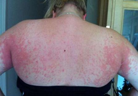 孕妇出现很多纹,孕妇肚子上长妊娠纹有拉扯感