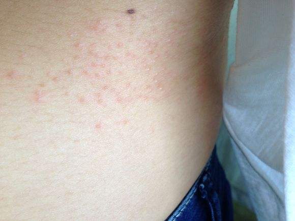 隐私部湿疹瘙痒用什么药,怀孕皮肤湿疹怎么办