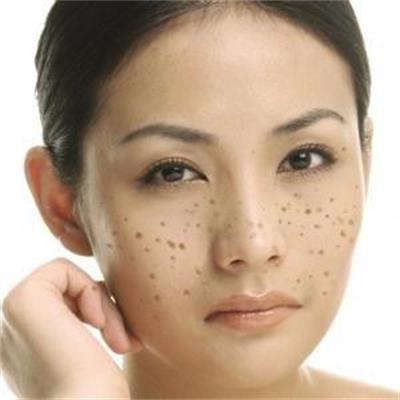雀斑真的可以用激光彻底祛除吗,激光祛除雀斑的利弊大揭秘