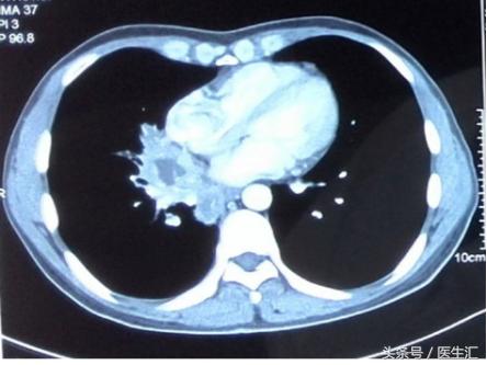 系统性血管炎怎么治才能除根,肾脏血管炎好治吗应该注意什么