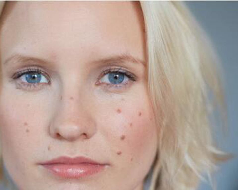 脸上痘痘内调怎么调理,脸上痘痘调理配方