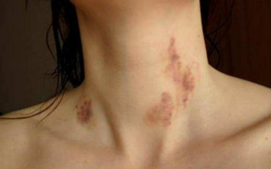 宝宝被年轻妈妈吻后中风丧命,“种草莓”游戏不能乱玩