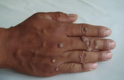 扁平疣和寻常疣和瘊子的区别,寻常疣扁平疣都是瘊子吗