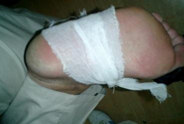 哎呀！不小心脚丫子踩到玻璃碎片上