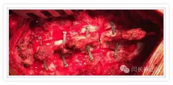 闫长祥脑膜瘤,闫长祥能治愈弥漫中线胶质瘤吗