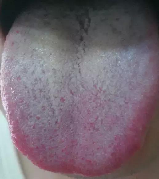 火不可乱降,上火应该做什么?