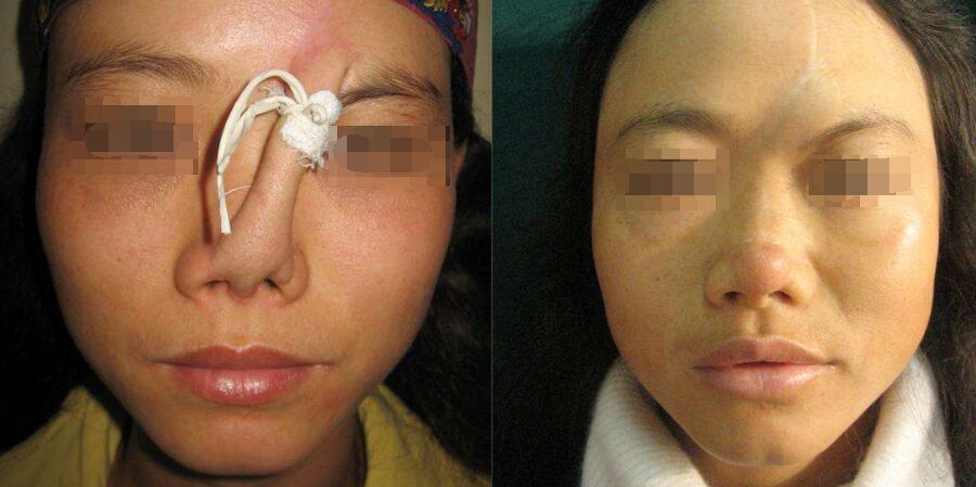 歪鼻子怎么办,歪鼻子有什么办法呢