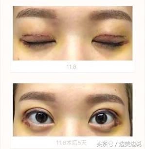 外科医生申霄,申霄医生双眼皮风格