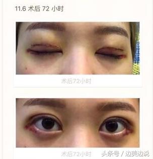 外科医生申霄,申霄医生双眼皮风格