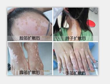 白癜风诊断及鉴别诊断,白癜风的鉴别与诊断