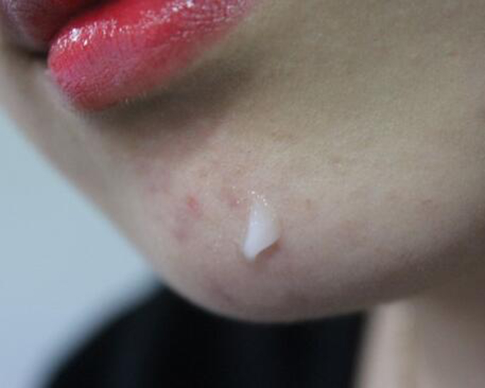 脸上突然长很多小痘痘是过敏吗,脸上过敏的痘痘怎样快速消除