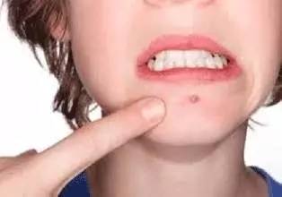 左侧下巴长痘的原因,下巴长痘擦什么药膏