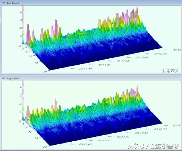 脑电波生物反馈治疗有帮助吗,阿斯伯格脑电波反馈训练