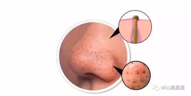 涓嶈姳閽辫繕鏈夋晥鐨勫幓榛戝ご鏂规硶get,娓╁拰楂樻晥鍘婚粦澶寸殑鏂规硶