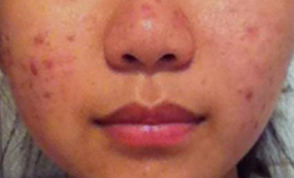 台州消除青春痘疤痕,男士青春痘疤痕怎么修复