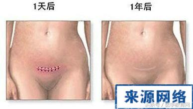 剖腹产女性手术,女的剖腹产手术的全部流程