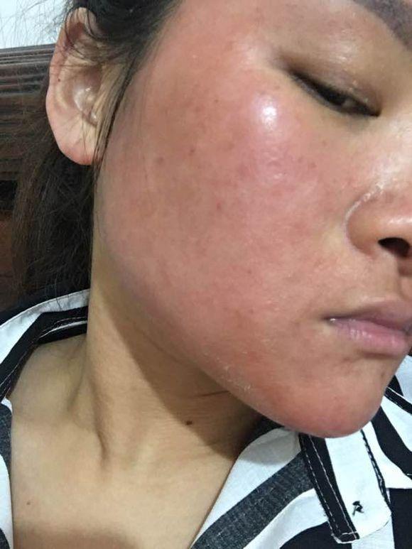 激素脸泛红发烫怎么办,激素脸发红发烫用什么药擦