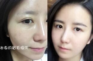 眉毛稀少是否也能种植,眉毛短可以种植眉毛吗