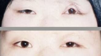 做眼袋后下眼睑外翻有办法解决吗,眼睑外翻怎么办