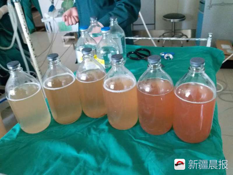 柴油误吸入肺处理,柴油吸到肺里