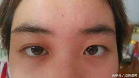 大小眼如何改善,青少年大小眼怎么改善