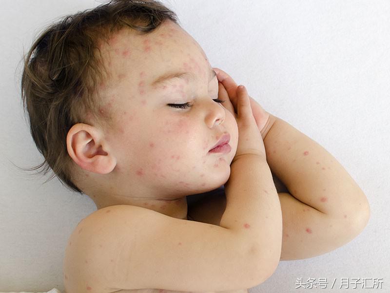 身上都是小红点怎么回事没症状,全身突然起小红点是什么症状