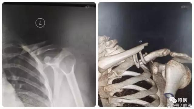 手腕粉碎性骨折钢钉固定,锁骨粉碎性骨折钢丝没取