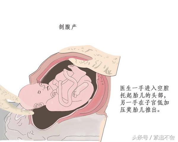 不看不知道，腹产对女人伤害居然这么大！