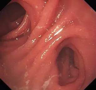 胃镜预处理流程,胃镜内镜手术全流程