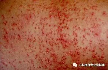 宝宝长痱子热疹,大人痱子和热疹