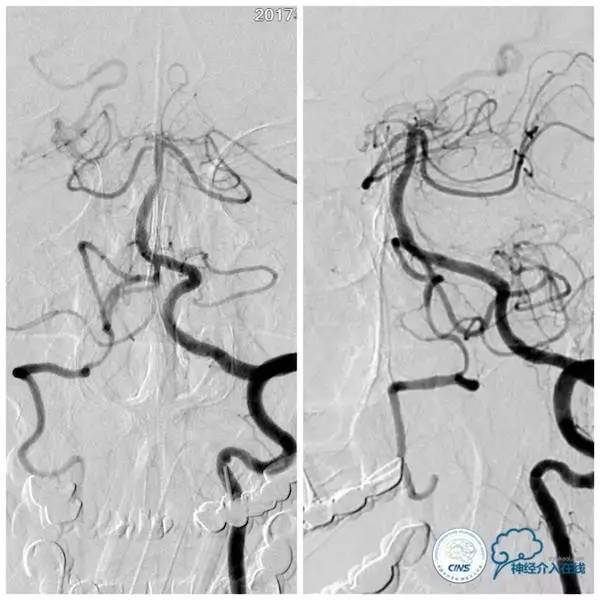 天坛周记,天坛医院脑动脉狭窄
