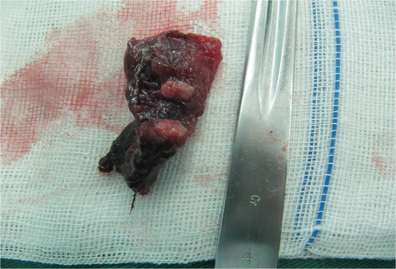 妊娠合并甲状腺疾病病例,妊娠合并甲状腺低下治疗