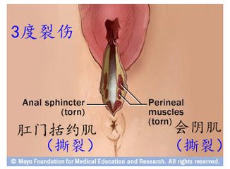 第67课：会阴侧切与撕裂