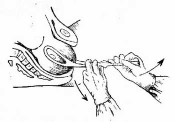 第6版妇产科护理学,第71课