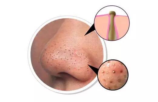 有效去黑头的方法让你摆脱草莓鼻,去黑头小妙招种草