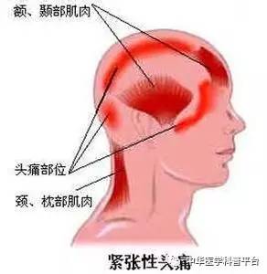 中医治疗紧张性头痛的方法,怎么缓解紧张头痛