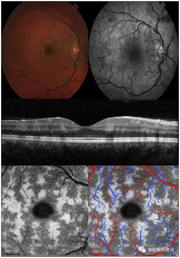 文摘速递丨横看成岭侧成峰,BC扫描各不同—PAMM的enface-OCT影像