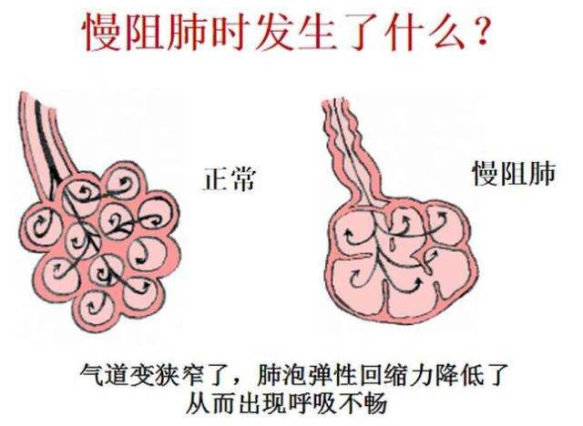 夏天慢阻肺肺气肿症状,夏天慢阻肺保养和食疗方法