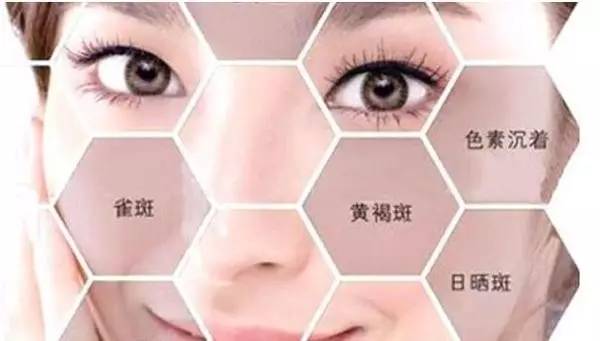 我满脸全是雀斑怎么办,满脸雀斑的我蜕变说说