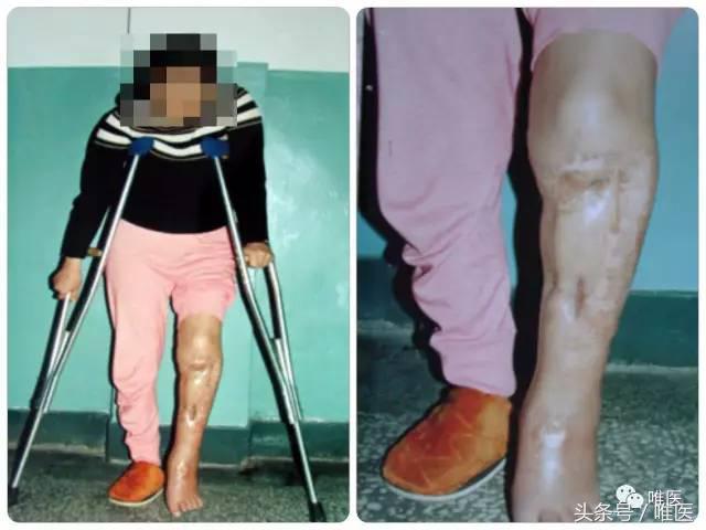 胫骨骨折骨缺损多大可以自愈,胫骨骨折有小块骨缺损影响吗