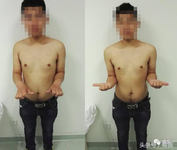 肱骨髓内钉的手术体位,肱骨髓内钉术后康复恢复步骤