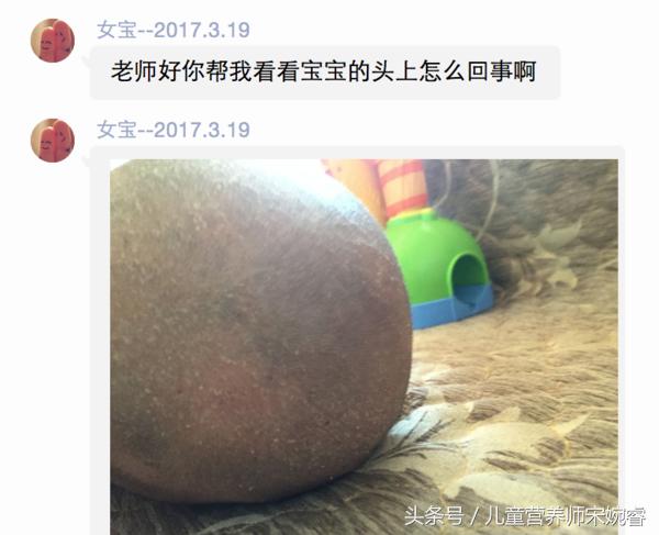 宝宝起头皮屑怎么处理,2个月宝宝皮屑太多了怎么回事