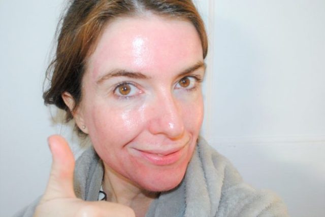 怎样才能祛痘去黑头去闭口,祛痘去黑头粉刺闭口