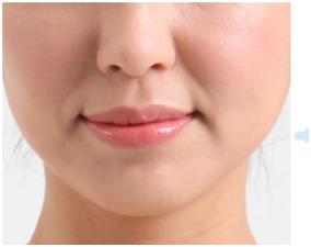 法令纹通过医美能保持多久,法令纹真的只有医美才能去除吗